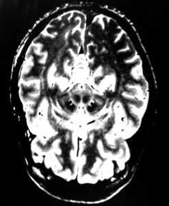 Scan of my brain. Dead centre there are two circular shapes, to the left and right are two semi-circular shaped which look like spanner ends. This is where the DBS electrodes are located. 